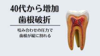 まさか破折が原因で歯を抜かなくてはいけなくなるんて！